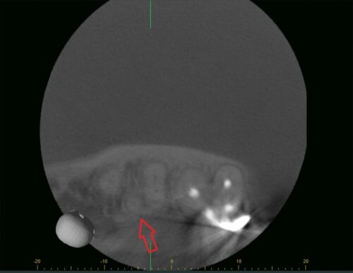 Case Profile: Navigating a Radix Paramolaris