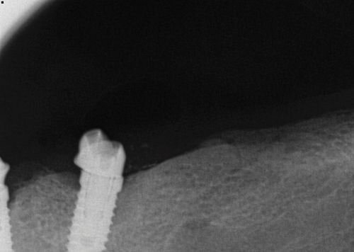 Calibrating Full-Arch Immediate Prosthetics with Condylar Centric in the Digital Era
