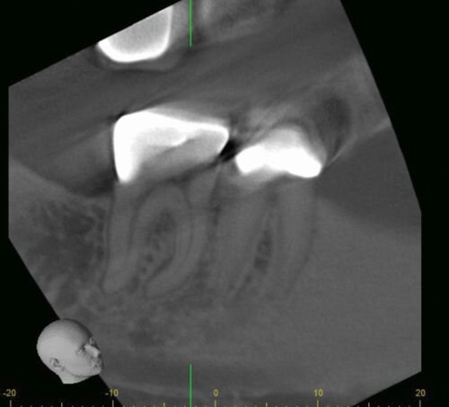 Case Profile: Navigating a Radix Paramolaris