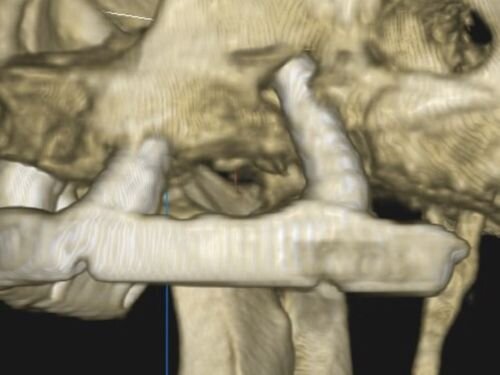 Calibrating Full-Arch Immediate Prosthetics with Condylar Centric in the Digital Era