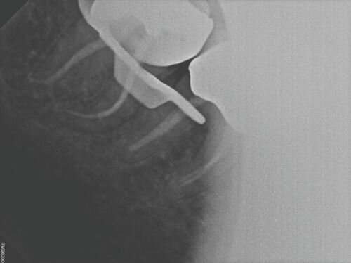 Case Profile: Navigating a Radix Paramolaris