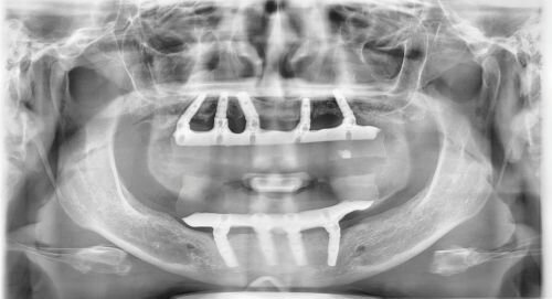 Calibrating Full-Arch Immediate Prosthetics with Condylar Centric in the Digital Era
