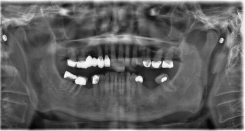 Case Profile: Navigating a Radix Paramolaris