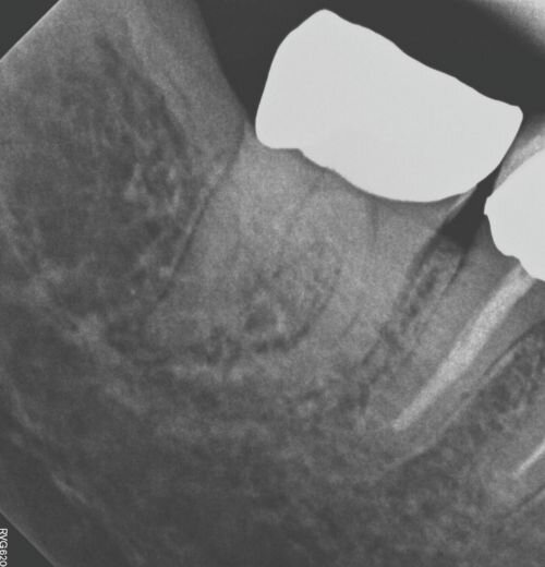 Case Profile: Navigating a Radix Paramolaris