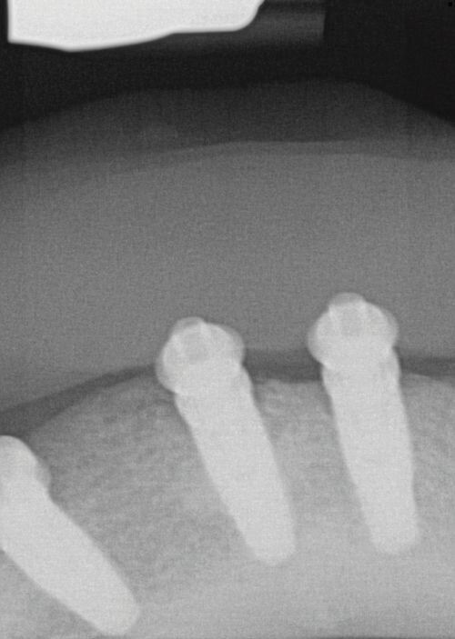 Calibrating Full-Arch Immediate Prosthetics with Condylar Centric in the Digital Era