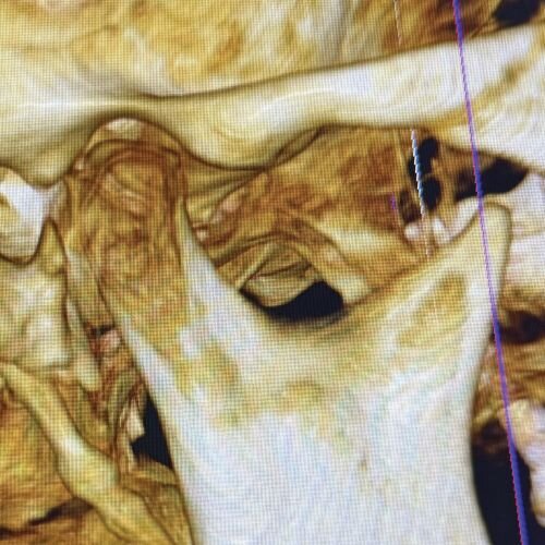 Calibrating Full-Arch Immediate Prosthetics with Condylar Centric in the Digital Era