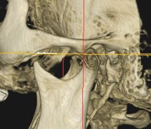Calibrating Full-Arch Immediate Prosthetics with Condylar Centric in the Digital Era