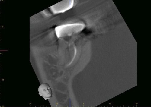 Case Profile: Navigating a Radix Paramolaris