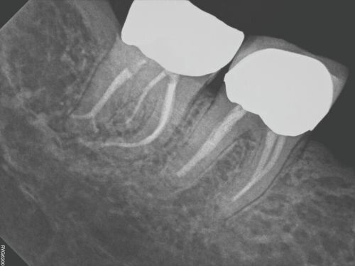 Case Profile: Navigating a Radix Paramolaris