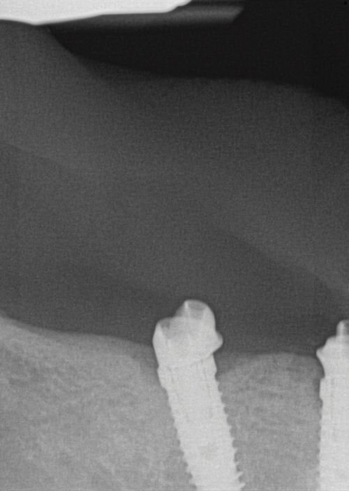 Calibrating Full-Arch Immediate Prosthetics with Condylar Centric in the Digital Era