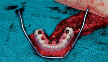 Building a Mandible Achieving Total Reconstruction in a Single Operation