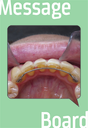 Orthodontics: Fixed Lingual Retainer Wire Townies discuss different types  of orthodontic retention.