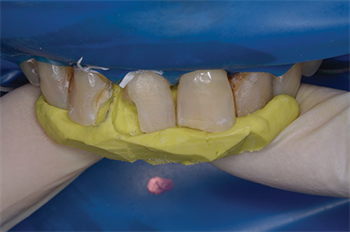 Putty in My Hands Direct Restoration in the Anterior Teeth Using Two Techniques