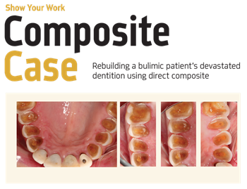 Show Your Work: Composite Case Dr. Terry Shaw shares a case in which he used composite to completely rebuild the dentition of a patient whose years of bulemia had eroded the back of her teeth. 