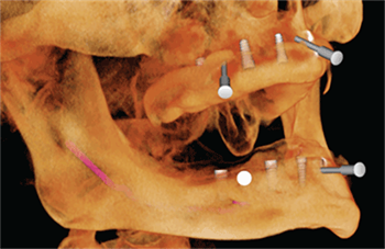 Beyond Implants Dr. Patrick L. McGee discusses how 3-D technology can expand treatment options when placing implants.