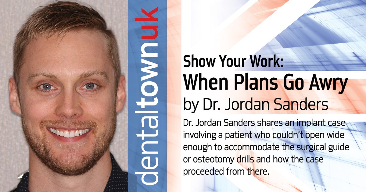 Show Your Work: When Plans Go Awry Dr. Jordan Sanders shares an implant case involving a patient who couldn’t open wide enough to accommodate the surgical guide or osteotomy drills and how the case proceeded from there.