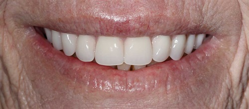 Creating an Affordable, Aesthetic Same-Day Full-Arch Prosthetic Dr. Grant Olson explains the technology and simplified restorative protocols that help dentists create same-day, immediate-load implant-retained prosthetics that are strong, aesthetic and cost-effective.