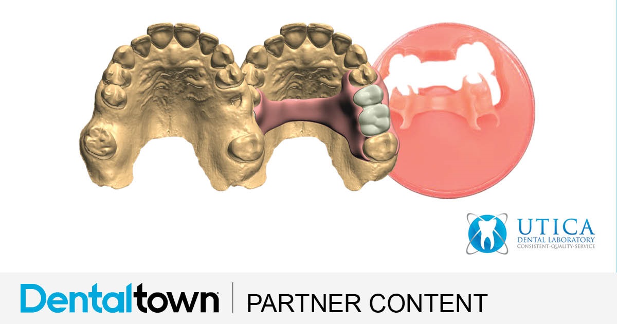 Product Profile: TCS 3D Flexible Partials