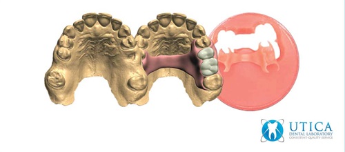 Product Profile: TCS 3D Flexible Partials A complete digital solution for partial dentures