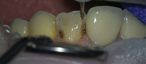 Show Your Work: Strike Up the Band! One of our top-followed Townies, Dr. Arthur R. Volker, shares a case study that illustrates how to use a dental matrix with the composite injection-molding technique to create a patient’s full-contour veneers. 