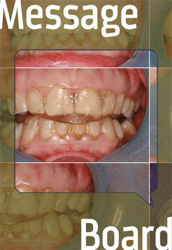 How Did This Happen? Townies discuss sleep bruxism and how to prevent occlusal wear.