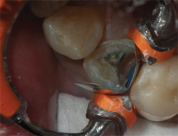 Practice Solutions: Voco A refresher course on glass ionomers and resin-modified glass ionomers