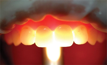 Show Your Work: Let the Light In Dr. Daniel Poticny shares a case in which he created lifelike restorations on a patient who had significant wear on teeth #8 and #9.