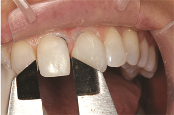 A Predictable Way to Close the Gap Dr. James Peyton shares a case study about a simple way to close a diastema. 