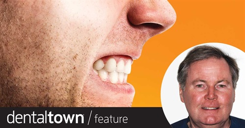 Reversing the Grind One of our most-followed Townies, Dr. Terry Shaw, shares a case in which he treated a well-known Canadian tenor’s severely worn dentition over two visits by rebuilding the patient’s upper and lower teeth with composite.