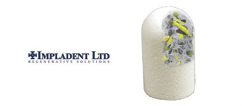 Product Profile: OsteoGen Bone Grafting Plug Impladent Ltd: One-step bone grafting solution for socket preservation without a membrane