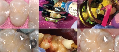Show Your Work: Stacking the Odds for Success Dr. Nichole Lubberts shares a case in which she performed Class II restorations on multiple teeth in the same quadrant. By using a streamlined workflow and resin-based composite materials for natural aesthetics, the procedures were done quickly without sacrificing quality. 