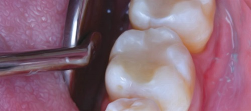 Posterior Protocol When Dr. Christina Pruitt’s patient complained of cold sensitivity, she discovered his old amalgam restorations were failing. To save existing tooth structure as well as money, he opted for direct composite restorations instead of an indirect crown—and he was so pleased with the result, he scheduled an appointment so Pruitt could replace two other, nonfailing amalgam fillings on the opposite side of his lower arch as well.