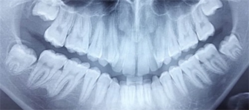 Clinical Case Spotlight: Nonsurgical Underbite Treatment Drs. Anthony D. Viazis and Evangelia Dartzalopoulou discusses a patient case in which a general dentist treated a patient’s complete underbite in centric occlusion using only brackets and an archwire. 