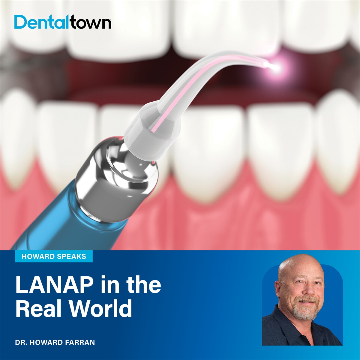 LANAP in the Real World