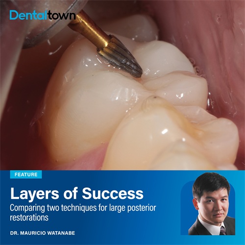 Layers of Success Dr. Mauricio Watanabe compares direct and indirect composite techniques for large posterior restorations, highlighting clinical considerations, aesthetic outcomes and material performance.
