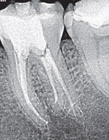 CE: Radix Entomolaris: Treatment of a Mandibular First Molar with Distolingual Root Mandibular molars may present anatomical variations such as an additional distal root (Radix Entomolaris).  Drs. Andrés Villanueva Ortiz and Juan Carlos Lema Rama discuss the diagnosis and root-canal treatment of a patient presenting with this symptom