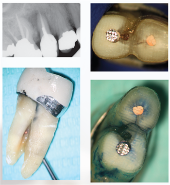 Contemporary Endodontics Dr. Daniel J. Boehne discusses how CBCT helps endodontists understand the morphology of individual teeth—and how using conservative root shapes can lead to predictable results as long as clinicians are willing to properly embrace technology.