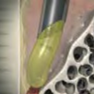 In Periodontics, Can We Regenerate Lost Hard and Soft Tissue? The benefits of Straumann Emdogain 