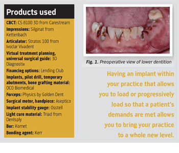 Show Your Work: All in a Day’s Work Dr. Ara Nazarian shares a case he finished in one day where a patient wanted fixed restorations supported by dental implants.