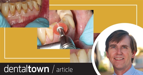 Show Your Work: Finish, Polish and Forget It Dr. James H. Peyton demonstrates how to create composite restorations that stand the test of time.