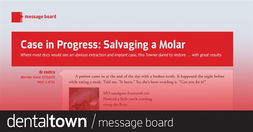 Salvaging a Molar:  Case in Progress Where most doctors would see an obvious extraction and implant case, this Townie dared to restore … with great results.