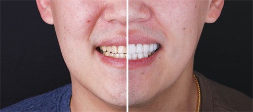 An Affordable Aesthetic Dr. Tu-Anh Vu shares a minimally invasive approach of a full-mouth rehabilitation in a case of severe erosion. The patient was treated with a direct composite technique
using a stent, providing them with a low-cost solution to worn dentition that can have a functional and aesthetic outcome.