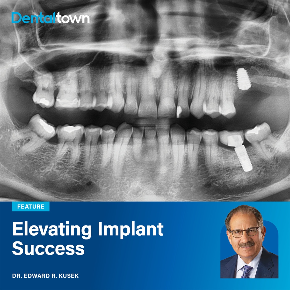Elevating Implant Success