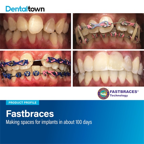 Product Profile: Fastbraces Making spaces for implants in about 100 days