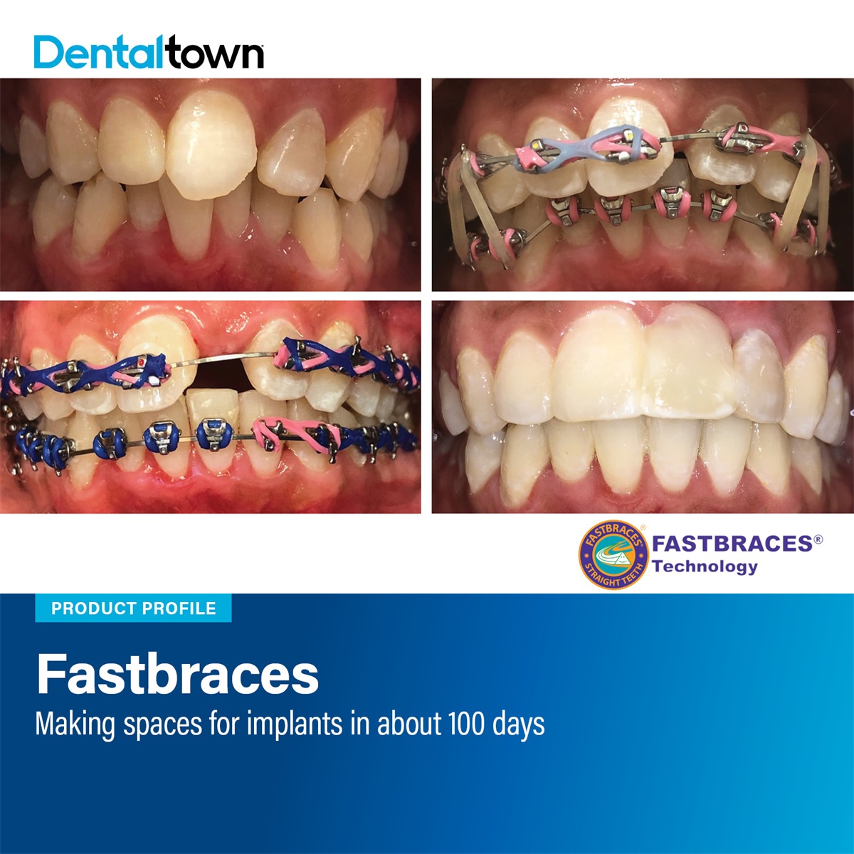 Product Profile: Fastbraces