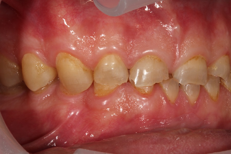 Full Mouth Rehabilitation - From Diagnosis to Delivery & Equilibration