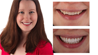 Dreaded Reverse Smile Line: Second Violation of Smile Design 