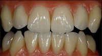 The Myth About Denture Patients