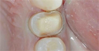 Questions to Ask When Ceramic De-bonds