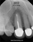 Apicoectomies Preserve Teeth & Periodontium